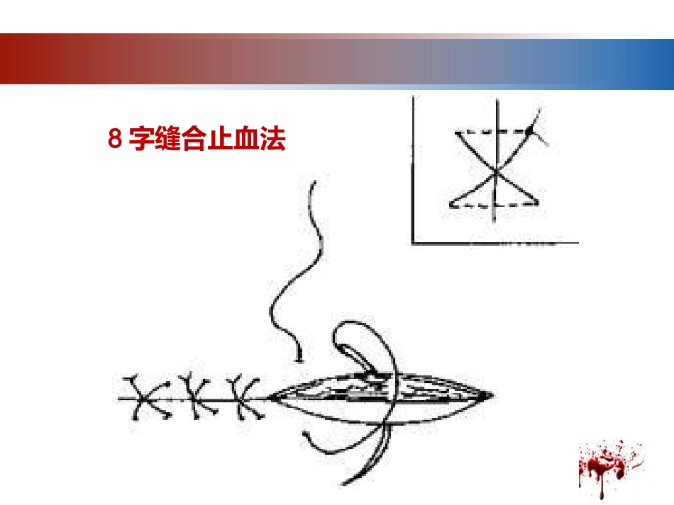 28.开放性伤口的止血技术_第12页
