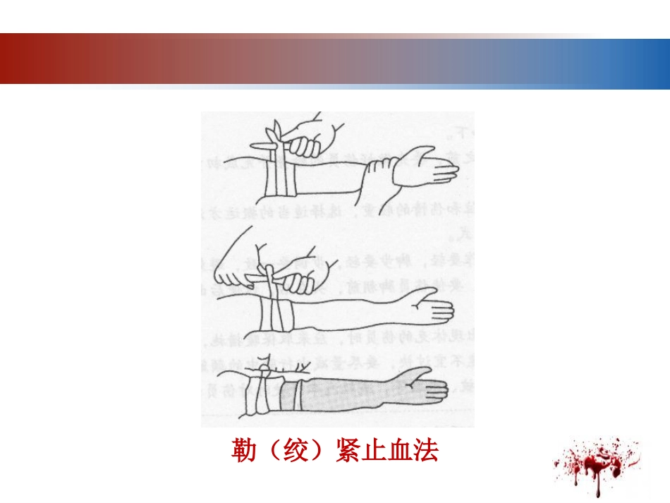 28.开放性伤口的止血技术_第15页
