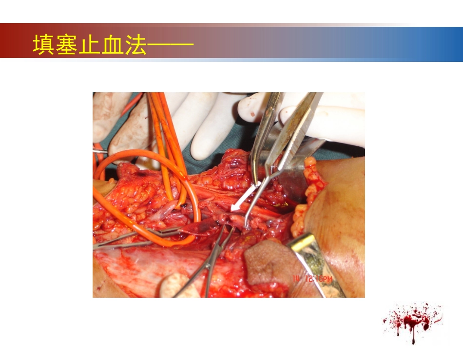 28.开放性伤口的止血技术_第4页