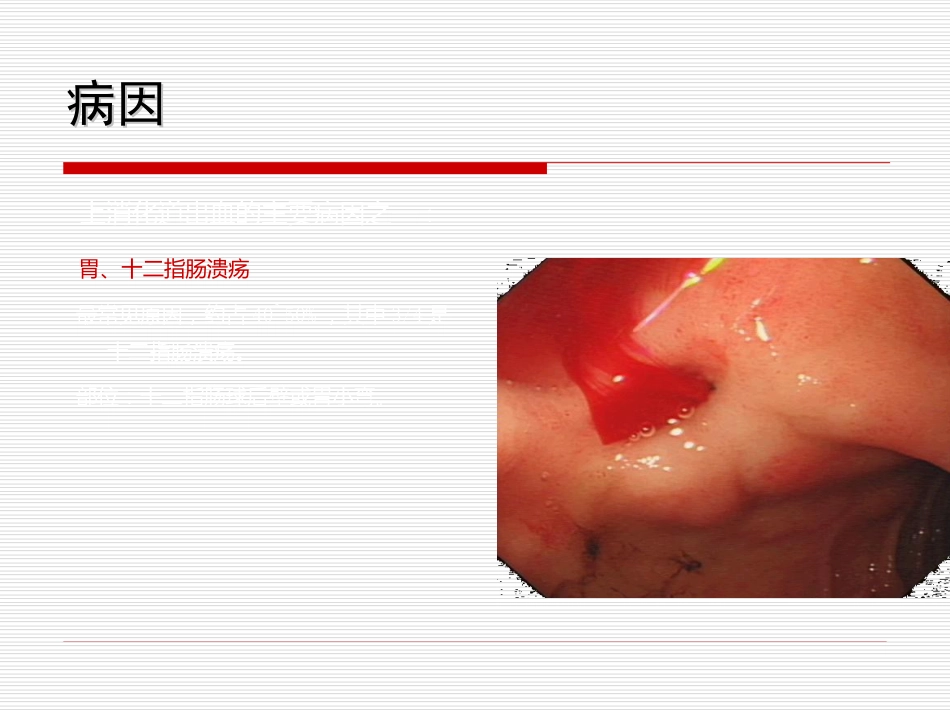 34.上消化道大出血_第13页