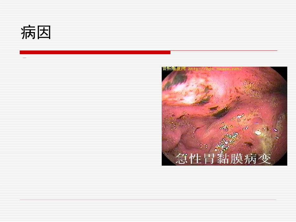 34.上消化道大出血_第15页
