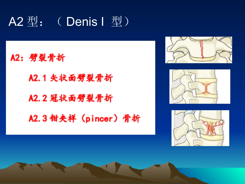 外科学：脊柱骨折常用分型及治疗原则_第15页