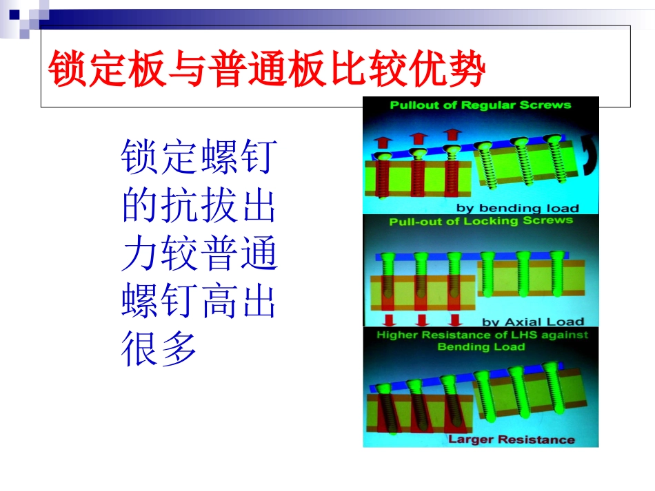 外科学：锁定钢板的应用及注意事项_第10页