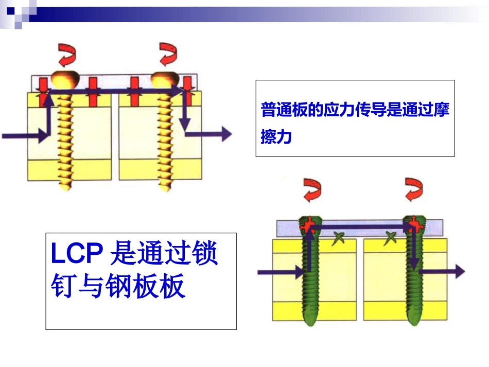 外科学：锁定钢板的应用及注意事项_第8页