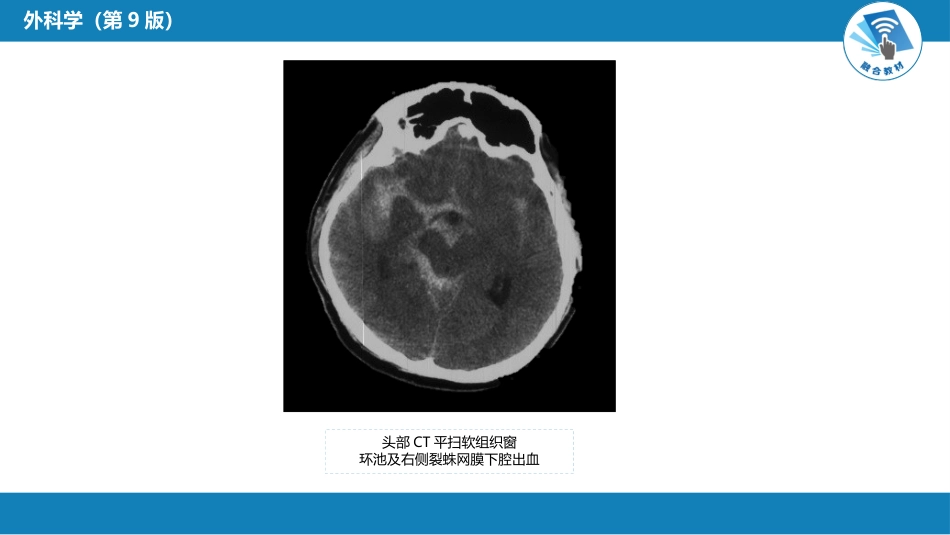 外科学：颅内和椎管内血管性疾病（自发性蛛网膜下腔出血，颅内动脉瘤，颅内和脊髓血管畸形）_第14页