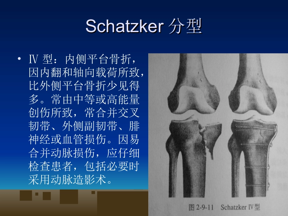 外科学：胫骨平台骨折的诊断及治疗_第10页