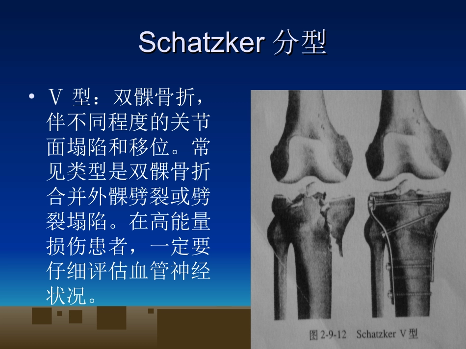 外科学：胫骨平台骨折的诊断及治疗_第11页