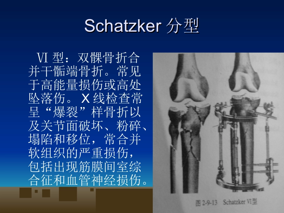外科学：胫骨平台骨折的诊断及治疗_第12页