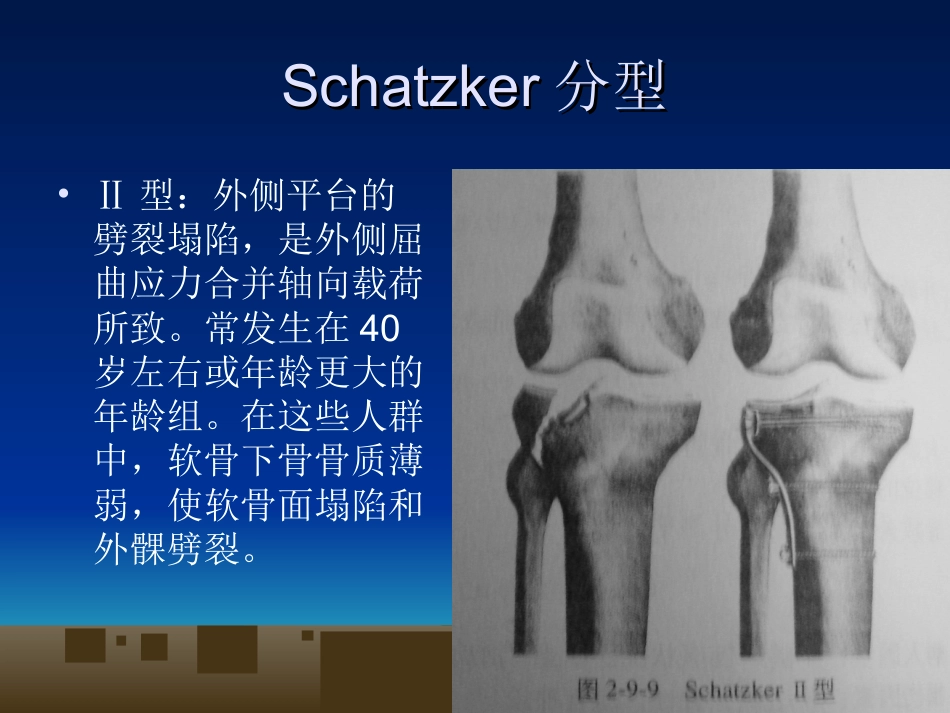 外科学：胫骨平台骨折的诊断及治疗_第8页