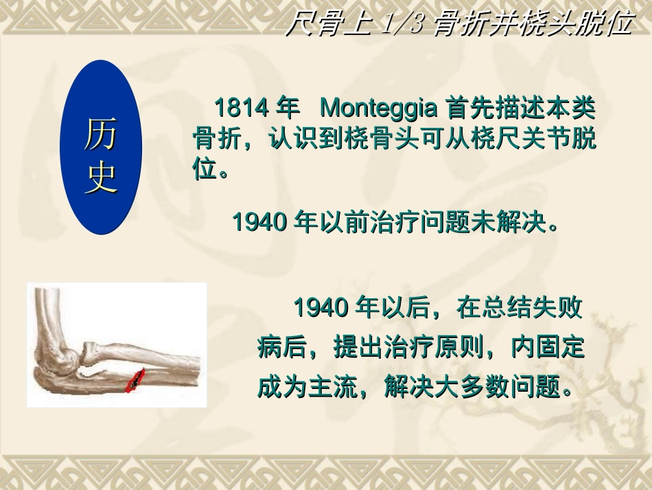外科学：孟氏骨折_第3页