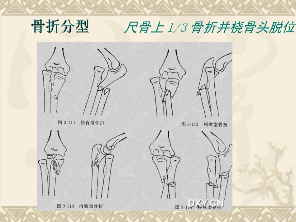 外科学：孟氏骨折_第9页