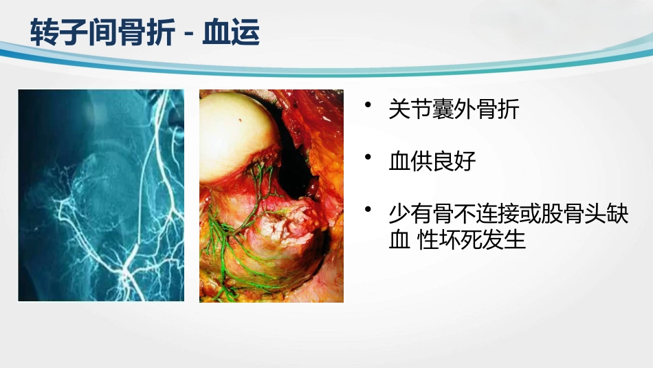 外科学：转子间骨折(2)_第3页