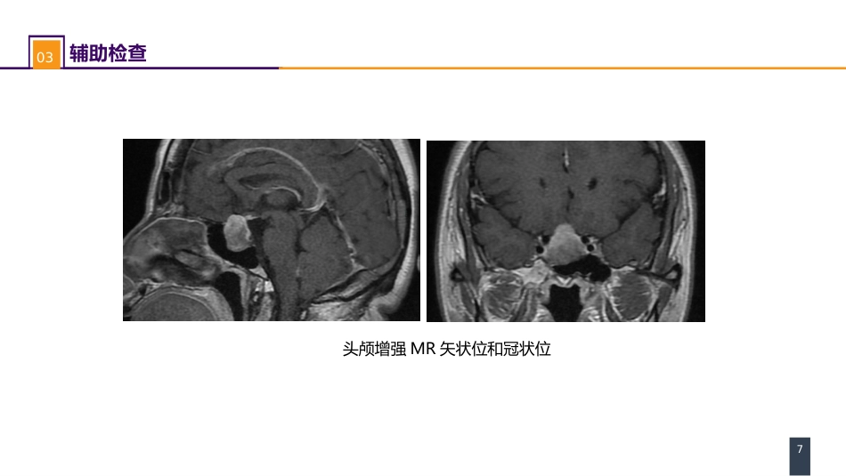 外科学：案例分析-垂体腺瘤_第7页