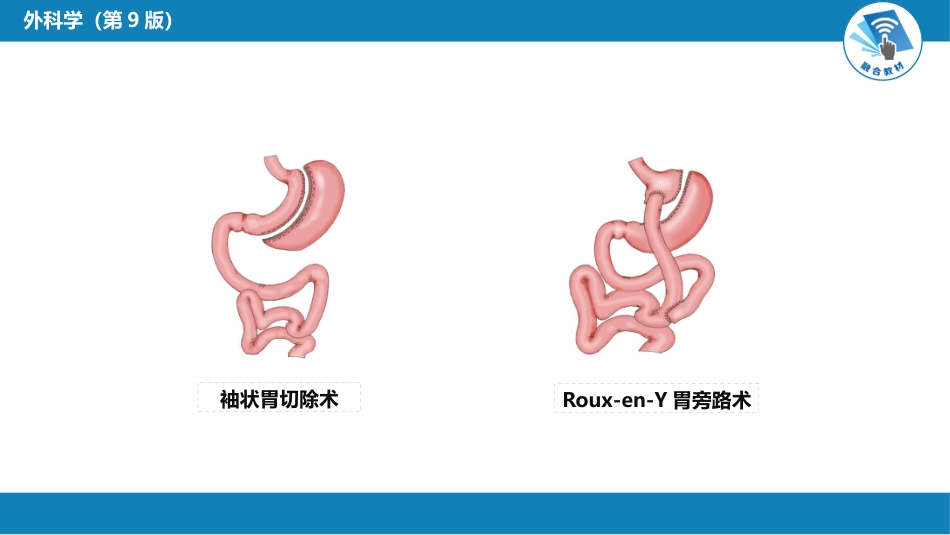 外科学： 肥胖与代谢病外科_第12页
