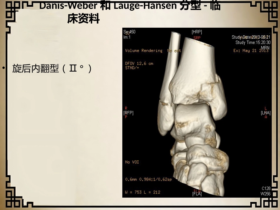 外科学：踝关节骨折的分型_第13页