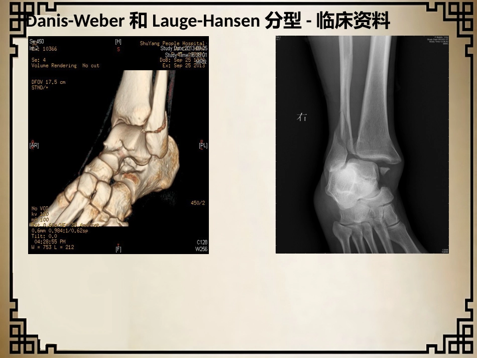 外科学：踝关节骨折的分型_第15页