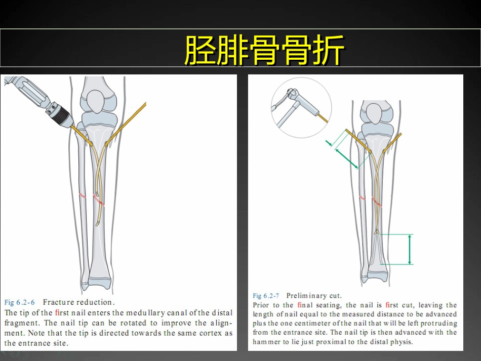 外科学：儿童长骨骨折弹性髓内钉课件_第10页