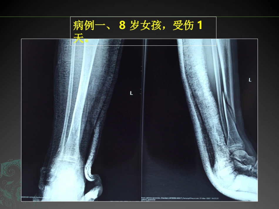 外科学：儿童长骨骨折弹性髓内钉课件_第11页