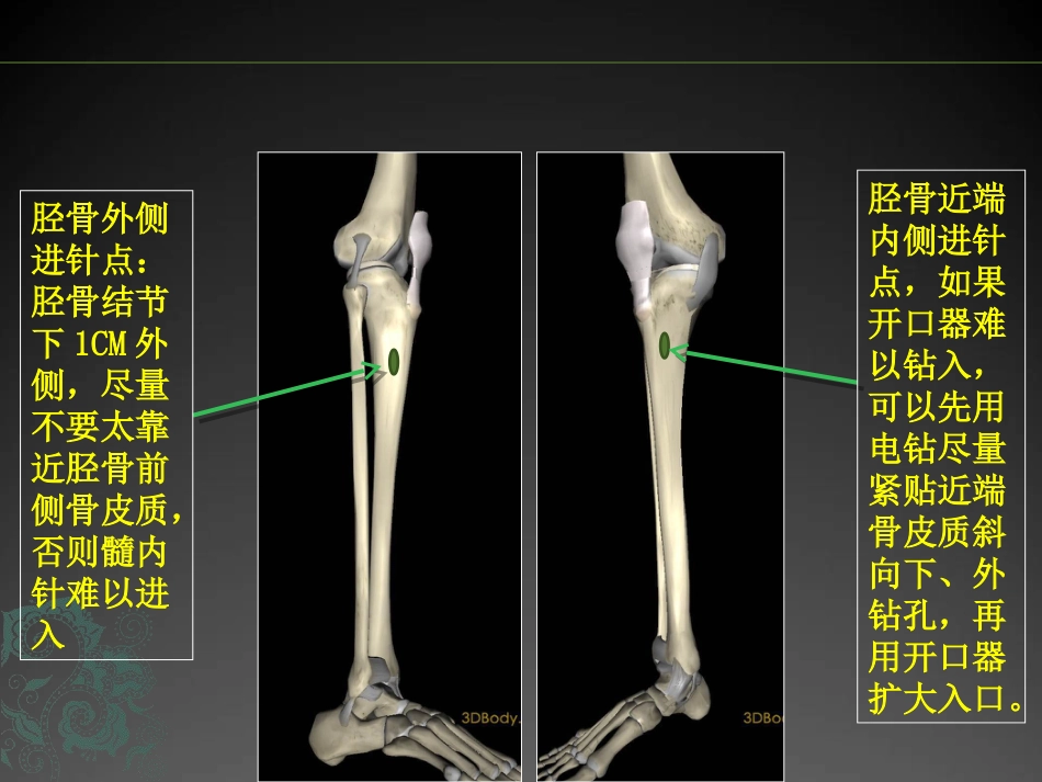 外科学：儿童长骨骨折弹性髓内钉课件_第12页