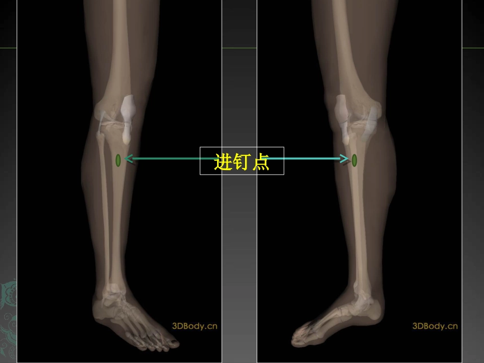 外科学：儿童长骨骨折弹性髓内钉课件_第13页
