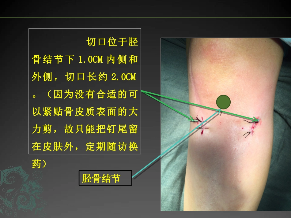 外科学：儿童长骨骨折弹性髓内钉课件_第14页