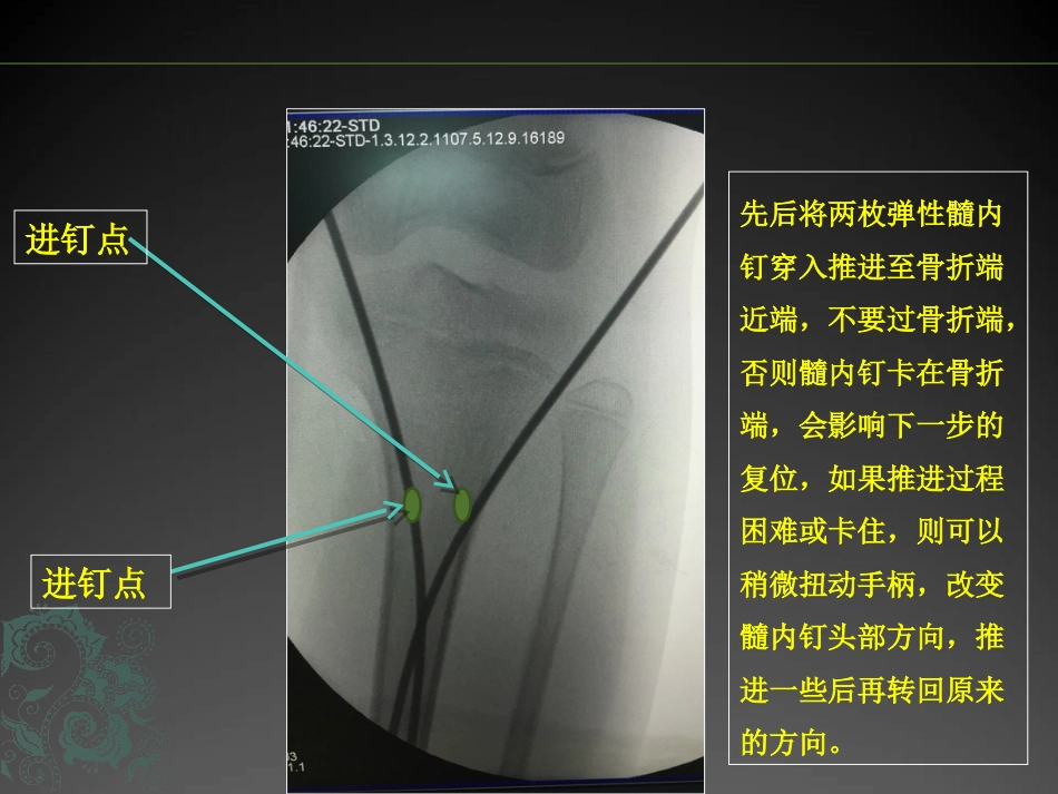外科学：儿童长骨骨折弹性髓内钉课件_第15页