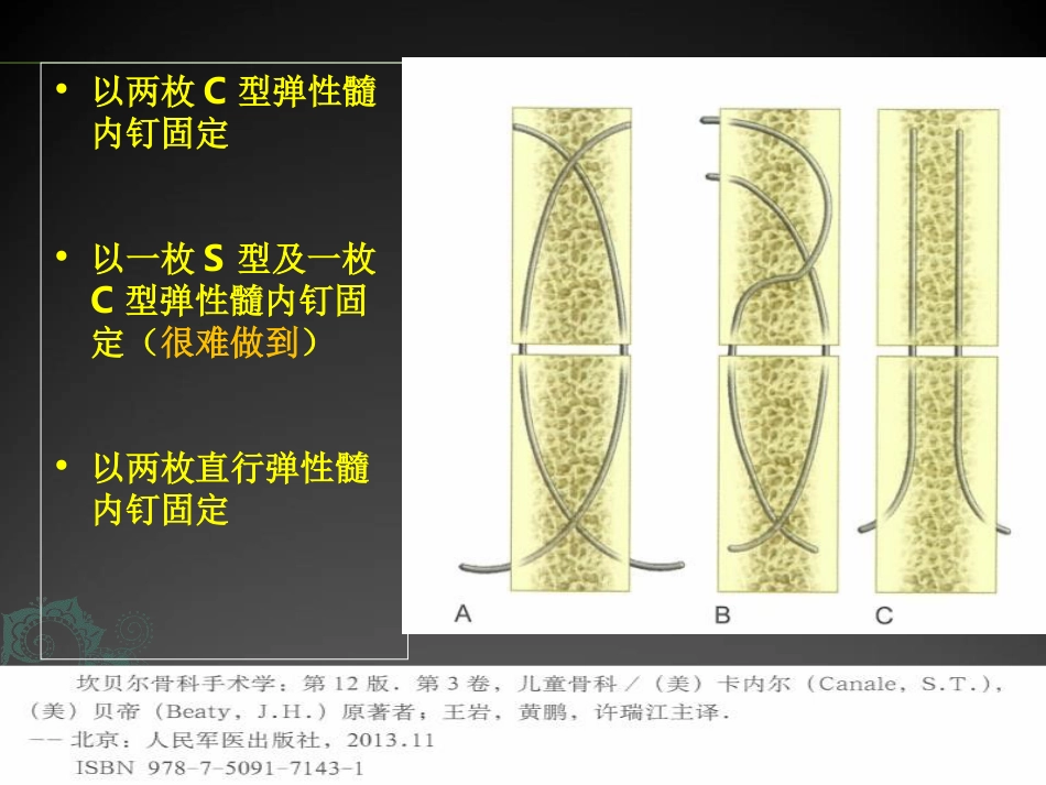 外科学：儿童长骨骨折弹性髓内钉课件_第4页
