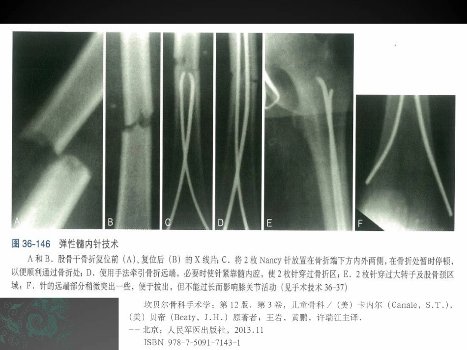 外科学：儿童长骨骨折弹性髓内钉课件_第5页