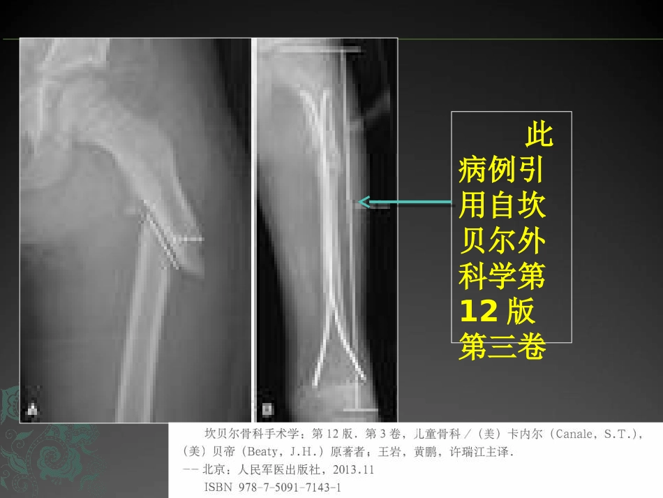 外科学：儿童长骨骨折弹性髓内钉课件_第6页