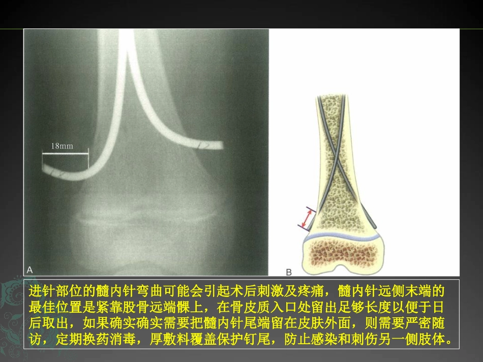 外科学：儿童长骨骨折弹性髓内钉课件_第7页