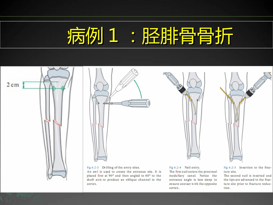 外科学：儿童长骨骨折弹性髓内钉课件_第9页