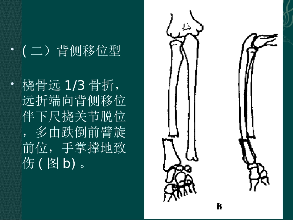 外科学：盖氏骨折_第10页