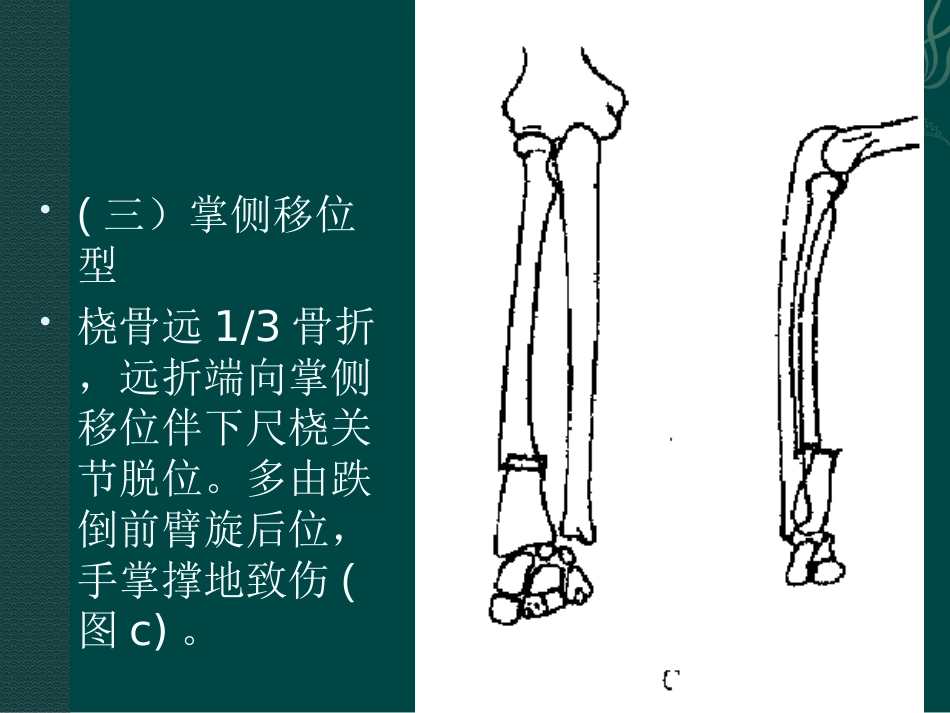 外科学：盖氏骨折_第11页
