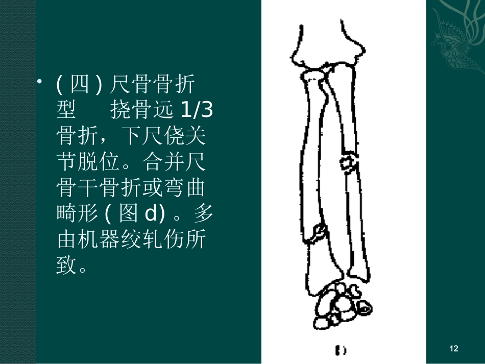 外科学：盖氏骨折_第12页