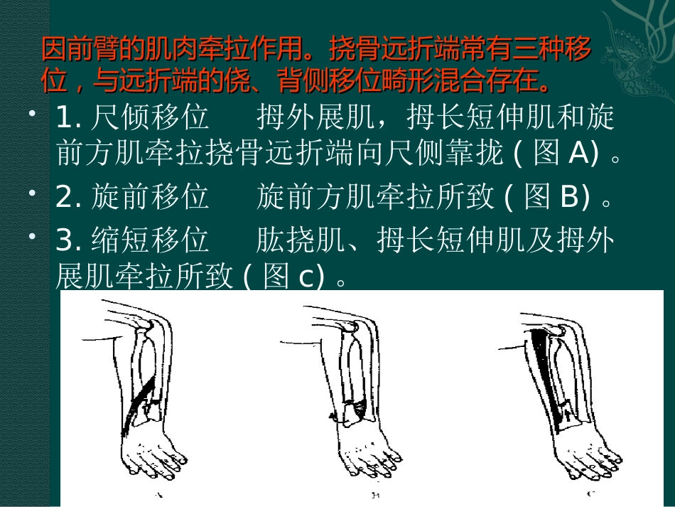 外科学：盖氏骨折_第13页