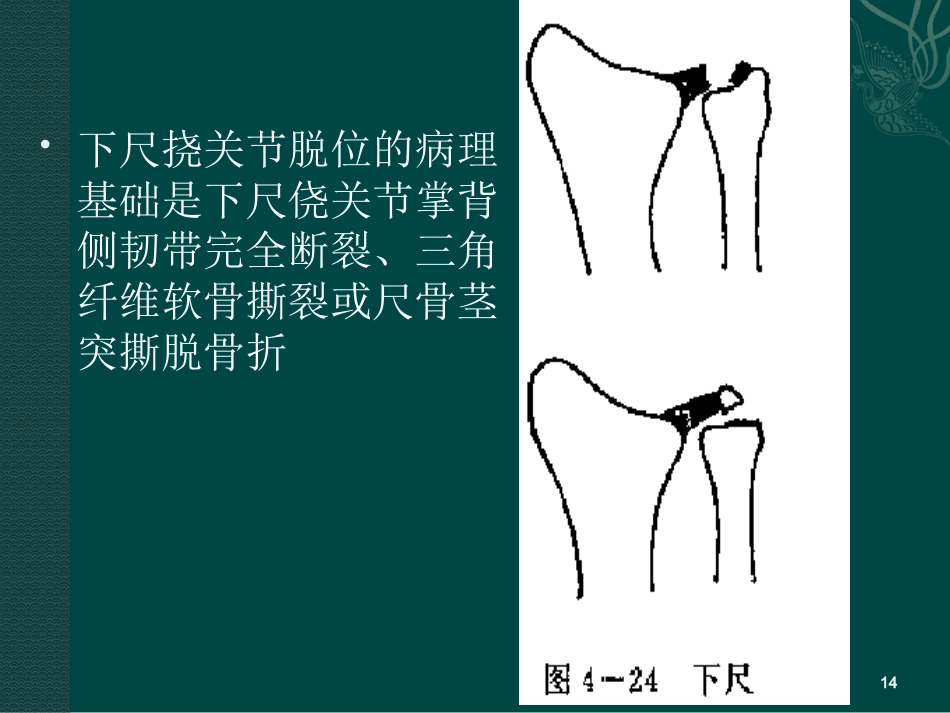 外科学：盖氏骨折_第14页