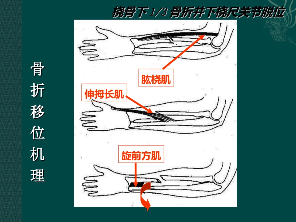 外科学：盖氏骨折_第15页