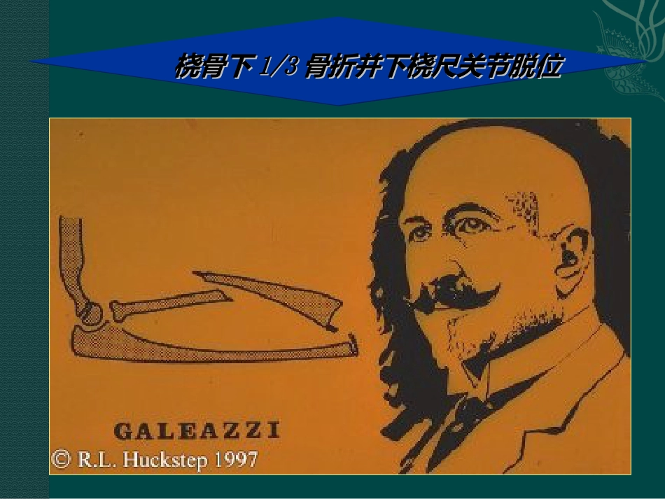 外科学：盖氏骨折_第4页