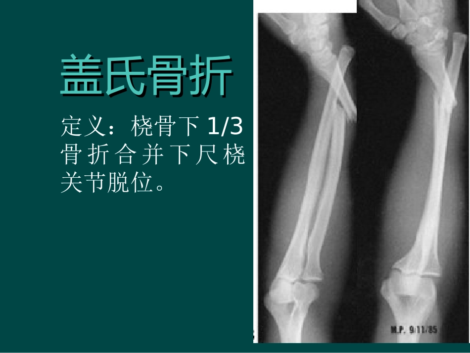 外科学：盖氏骨折_第5页