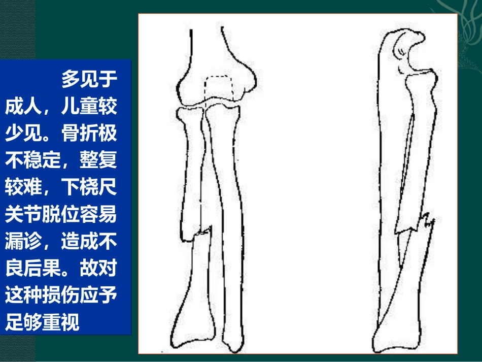 外科学：盖氏骨折_第7页
