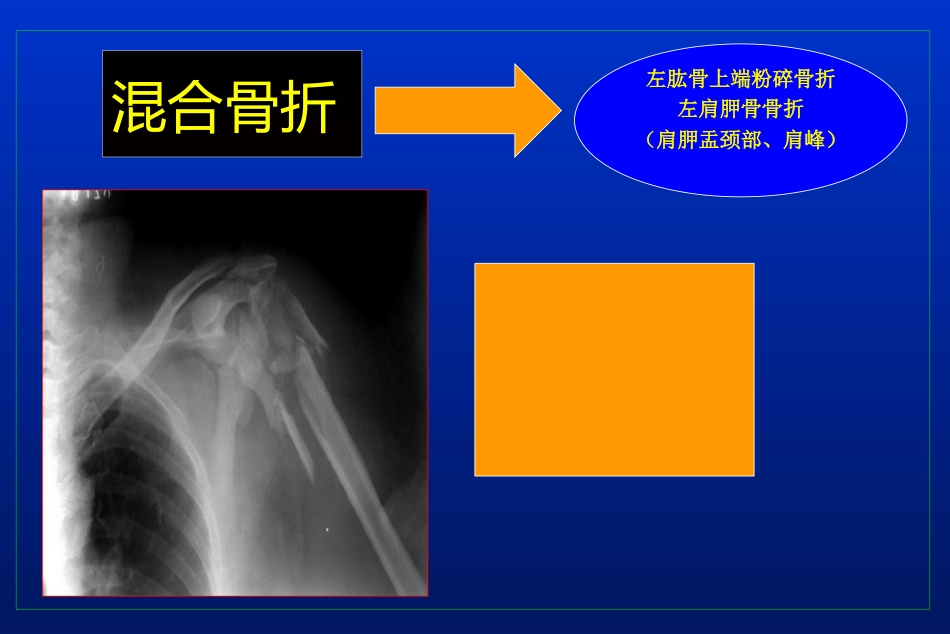 外科学：肩胛骨骨折_第12页