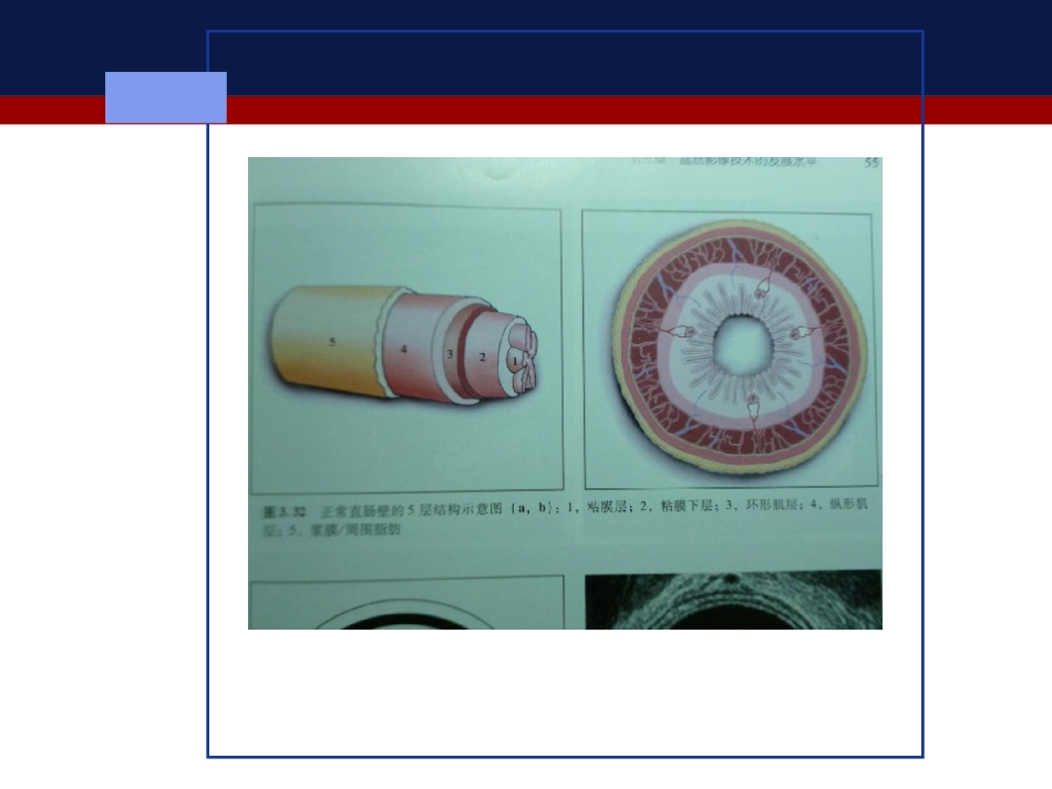 肛管内超声检查肛周脓肿和肛瘘_第8页