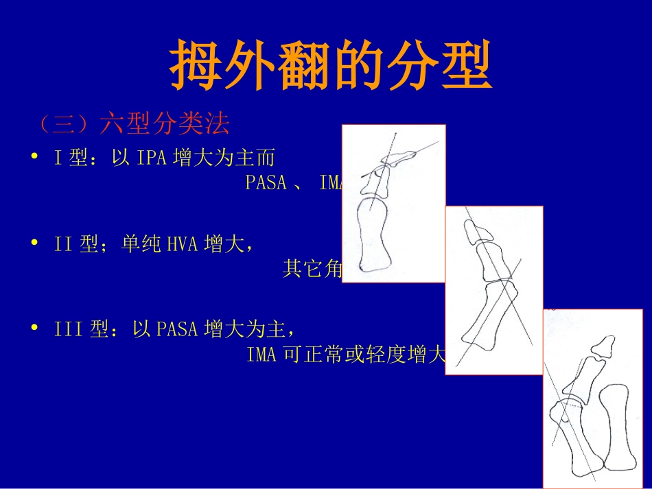 外科学：拇外翻的概念与分型_第11页