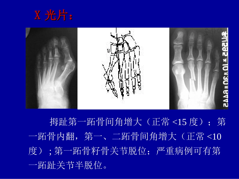 外科学：拇外翻的概念与分型_第4页