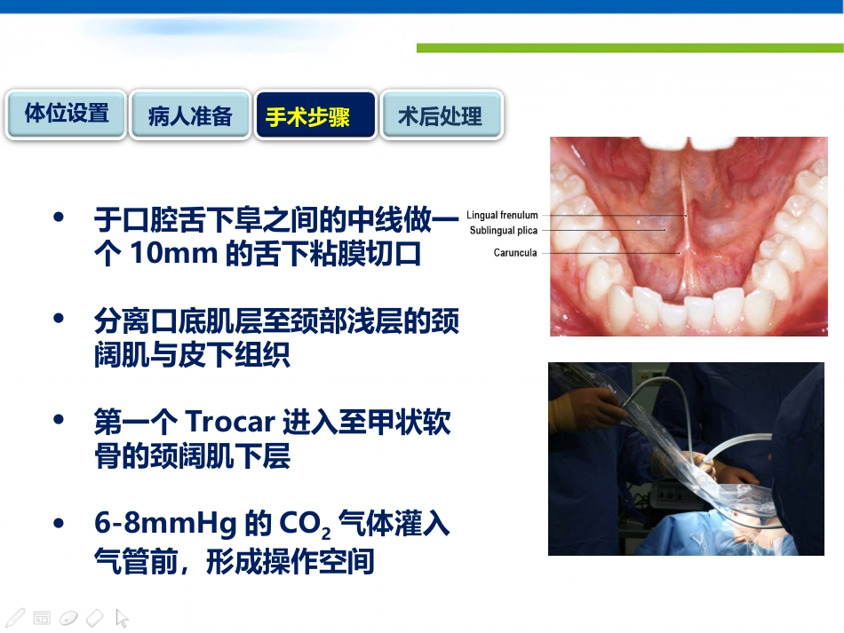 经口入路腔镜甲状腺切除术课件_第10页