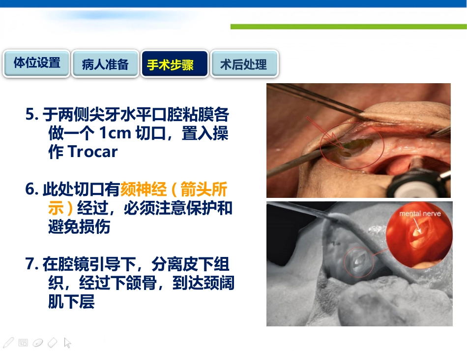 经口入路腔镜甲状腺切除术课件_第11页
