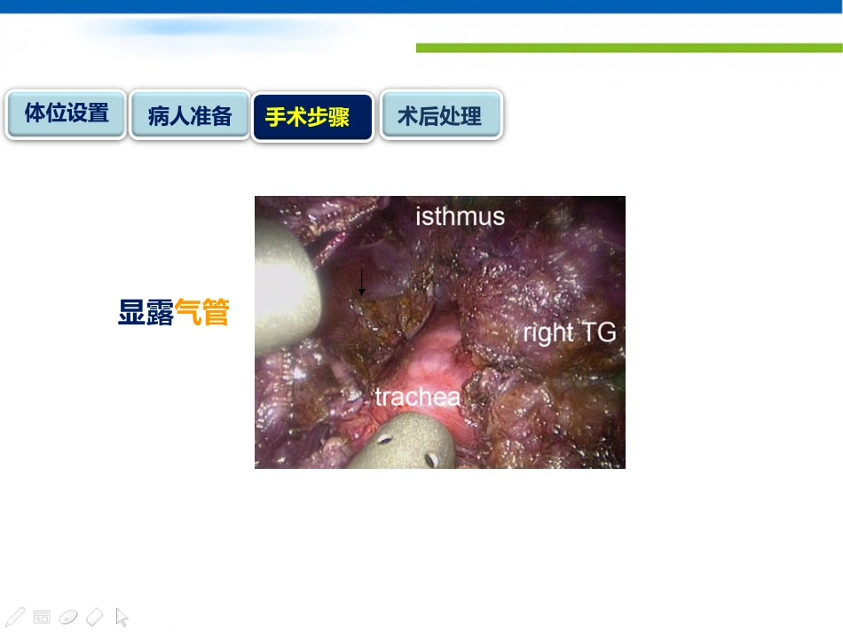 经口入路腔镜甲状腺切除术课件_第13页