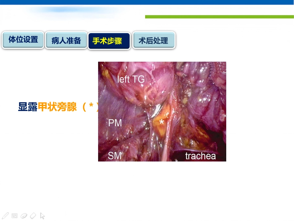 经口入路腔镜甲状腺切除术课件_第14页