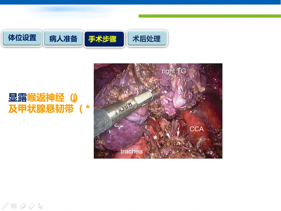 经口入路腔镜甲状腺切除术课件_第15页