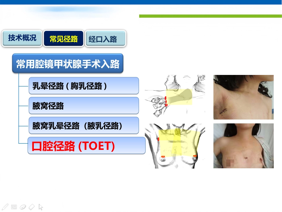 经口入路腔镜甲状腺切除术课件_第2页